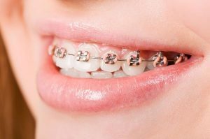Bendigo Smiles Dentist | Orthodontics | Dentist Bendigo