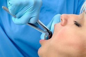 Bendigo Smiles Dentist | Tooth Extractions | Dentist Bendigo