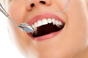 Bendigo Smiles Dentist | Tooth-coloured Fillings | Dentist Bendigo
